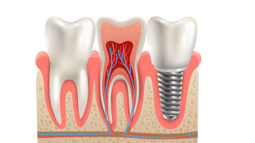 implant tooth replacement