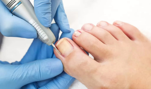 ingrown toenail removal doctor